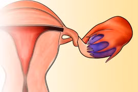 Xoắn phần phụ, cấp cứu phụ khoa nguy hiểm cần phát hiện sớm