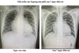 Điều trị thành công ca bệnh suy tim nặng ở trẻ em theo phác đồ mới 