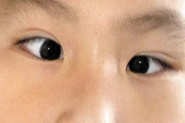 Chứng lác mắt ở trẻ tăng do sử dụng thiết bị điện tử
