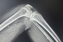 Phát hiện các mô vùng xương đùi, cẳng chân một bệnh nhân có nhiều kén sán