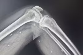 Phát hiện các mô vùng xương đùi, cẳng chân một bệnh nhân có nhiều kén sán