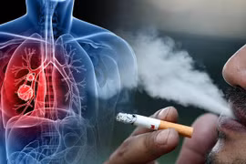 Ngăn ngừa ung thư qua kiểm soát yếu tố nguy cơ