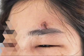Tự nặn mụn, bôi thuốc trôi nổi, thiếu nữ 15 tuổi tử vong