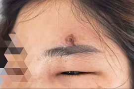 Tự nặn mụn, bôi thuốc trôi nổi, thiếu nữ 15 tuổi tử vong