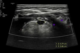 Nữ bệnh nhân 56 tuổi mắc dị tật nang ống giáp lưỡi hiếm gặp