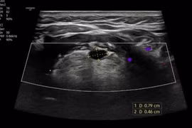 Nữ bệnh nhân 56 tuổi mắc dị tật nang ống giáp lưỡi hiếm gặp