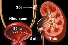 Phát hiện sỏi niệu quản sớm, điều trị kịp thời tránh biến chứng nguy hiểm