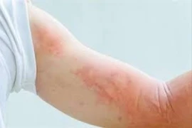 Bệnh giun sán gia tăng tại Khánh Hòa, hơn 290 ca dương tính trong 2 tuần