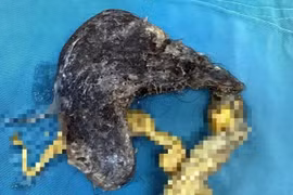 Búi tóc nặng nửa cân trong bụng bé trai 5 tuổi