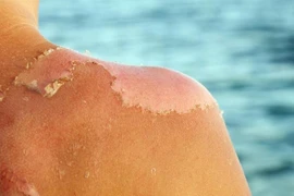 Cách phục hồi da cháy nắng mùa hè hiệu quả