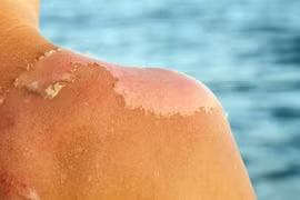 Cách phục hồi da cháy nắng mùa hè hiệu quả