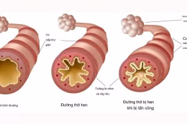 Phòng ngừa, kiểm soát hen suyễn để bảo vệ sức khỏe hô hấp