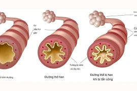 Phòng ngừa, kiểm soát hen suyễn để bảo vệ sức khỏe hô hấp