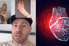 Động tác đơn giản kiểm tra phình động mạch chủ