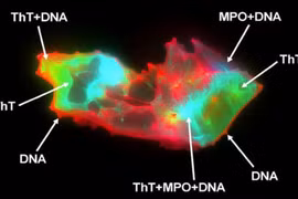 Phát hiện quan trọng có thể là nguyên nhân gây hội chứng Covid-19 kéo dài