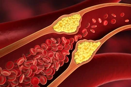 Hẹp động mạch cảnh - sát thủ thầm lặng gây nhồi máu não 