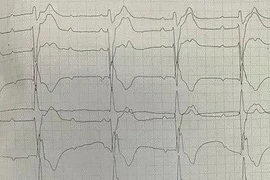 Cứu sống người đàn ông trẻ tim đập hơn 200 nhịp/phút, huyết áp tụt sâu