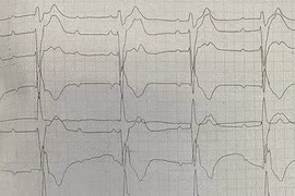 Cứu sống người đàn ông trẻ tim đập hơn 200 nhịp/phút, huyết áp tụt sâu