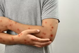 Bệnh đậu mùa khỉ xuất hiện ở Đồng Nai, lực lượng y tế đang truy vết nguồn lây