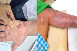 Bệnh nhân 70 tuổi bị nhiễm vi khuẩn Vibrio vulnificus gây hoại tử da