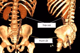 Phẫu thuật cấp cứu thành công cho nam giới bị dị vật xuyên bụng do tai nạn