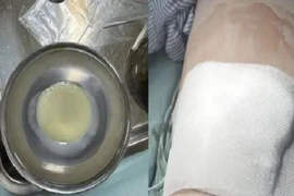 Cứu sống bé 2 tuổi bị áp xe cơ thắt lưng nguy kịch