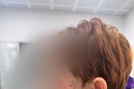 Bác sĩ lưu ý chứng tổn thương da nặng do mắc virus Herpes simplex