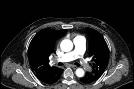 Cứu sống nam bệnh nhân 51 tuổi bị thuyên tắc phổi nguy kịch
