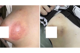 Cô gái 20 tuổi bị áp xe vú nặng sau khi tiêm chất làm đầy không rõ nguồn gốc