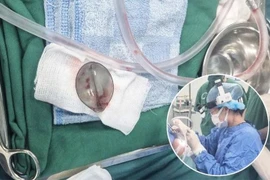 Phẫu thuật lấy muỗng nhựa trong đường thở cho bé trai 4 tuổi