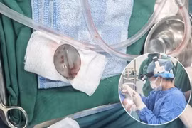 Phẫu thuật lấy muỗng nhựa trong đường thở cho bé trai 4 tuổi