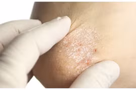 Cách tự nhiên giảm vảy nến hiệu quả trong mùa đông