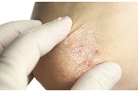 Cách tự nhiên giảm vảy nến hiệu quả trong mùa đông