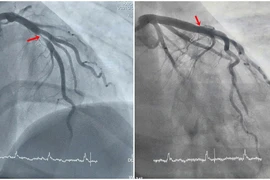 Bệnh nhân 29 tuổi phát hiện nhồi máu cơ tim qua điện tim trước nội soi