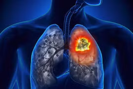 Dấu hiệu sớm cảnh báo ung thư phổi, cách phòng tránh