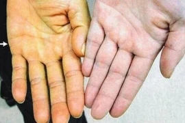 Viêm gan siêu vi B diễn tiến âm thầm, gây hậu quả nặng nề