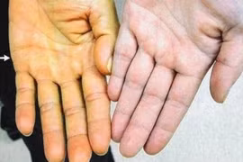 Viêm gan siêu vi B diễn tiến âm thầm, gây hậu quả nặng nề