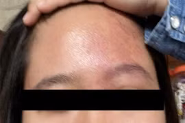 Người phụ nữ trẻ mắc hội chứng Sturge-Weber hiếm gặp