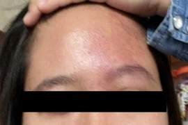 Người phụ nữ trẻ mắc hội chứng Sturge-Weber hiếm gặp