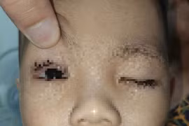 Bé trai 2 tuổi ở Ninh Bình nhập viện vì bỏng mắt do pháo hoa Trung thu