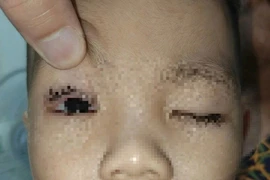 Bé trai 2 tuổi ở Ninh Bình nhập viện vì bỏng mắt do pháo hoa Trung thu