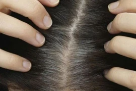 Nguyên nhân phổ biến gây tóc bạc sớm