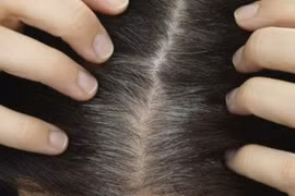 Nguyên nhân phổ biến gây tóc bạc sớm
