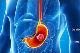 Tầm soát sớm ung thư dạ dày để không bỏ lỡ 'thời điểm vàng'