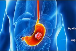 Tầm soát sớm ung thư dạ dày để không bỏ lỡ 'thời điểm vàng'