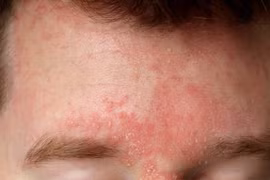 Cẩn trọng với bệnh lý da liễu mùa lạnh