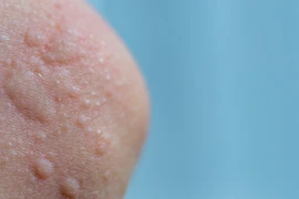 Giữ ấm cơ thể, phòng ngừa bệnh mày đay do lạnh