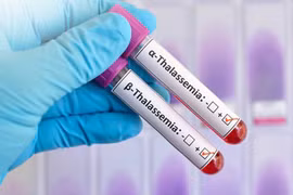 Phát hiện trẻ 19 tháng tuổi mang đột biến gene Thalassemia