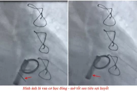 Cứu bệnh nhân 69 tuổi ở Quảng Ninh bị huyết khối kẹt van tim nhân tạo