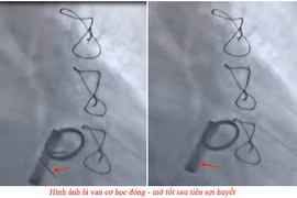 Cứu bệnh nhân 69 tuổi ở Quảng Ninh bị huyết khối kẹt van tim nhân tạo